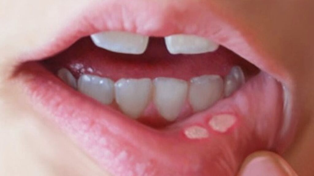 Siete remedios caseros para cuidar las llagas en la boca y la lengua